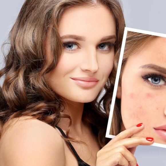 Removing Dark Marks and Scars from Face